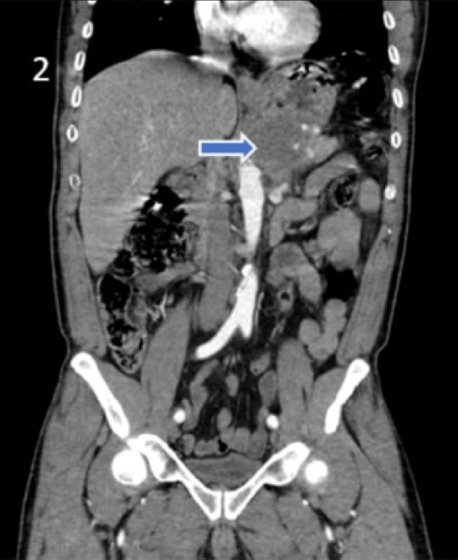 Case report and literature review of trophoblastic pancreatic carcinosarcoma presenting with gastric hemorrhage.