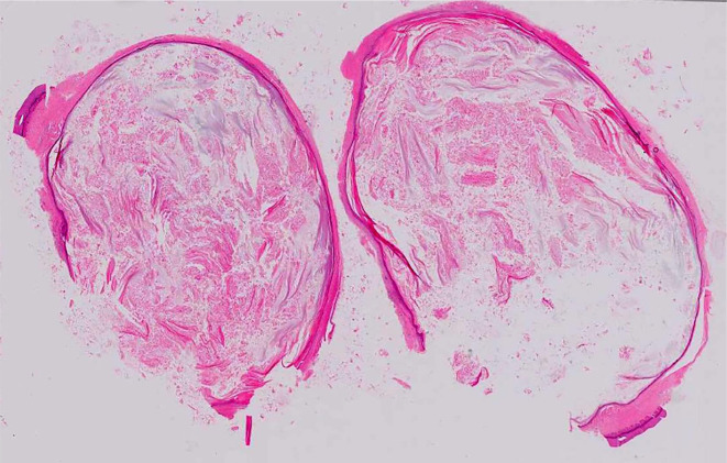 Guyon's canal syndrome caused by mass effect after chronic dog bite hand injury.