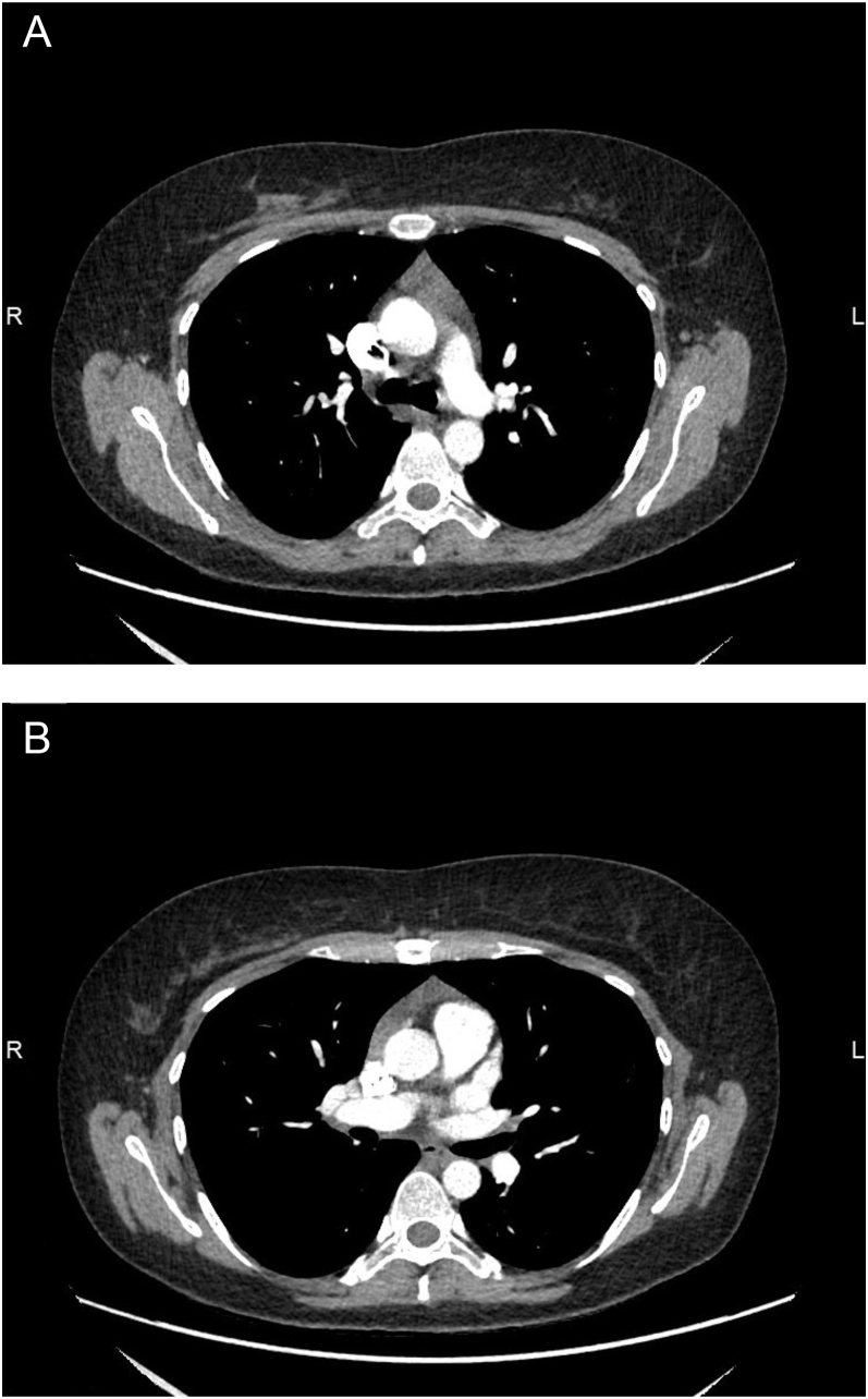Multi-disciplinary collaboration in diagnosing thymic hyperplasia in a Graves' disease patient.