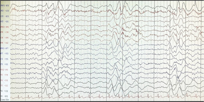 An interesting case of subacute sclerosing panencephalitis presenting with Balint's syndrome and dysautonomia.