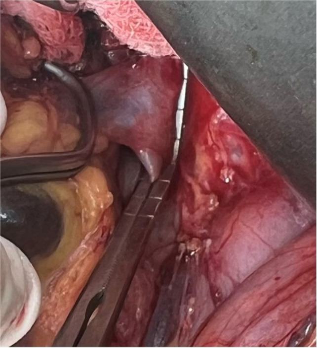 A Decade of Surgical Management of Renal Cell Carcinoma with IVC Thrombus and Bilateral Renal Tumors: Emphasis on Auto-transplantation.