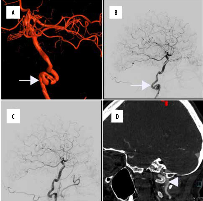 Endovascular stenting for extracranial internal carotid artery dissection - single-centre experience and literature overview.