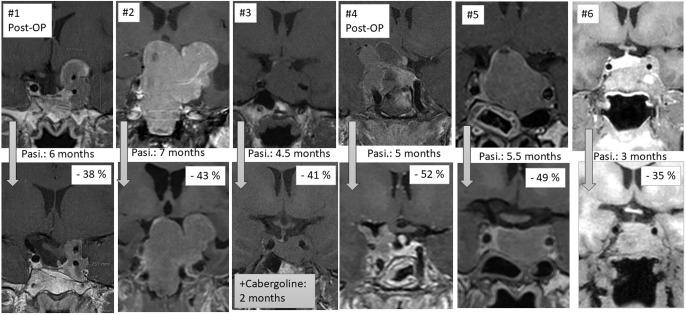 Pasireotide as first line medical therapy for selected patients with acromegaly.