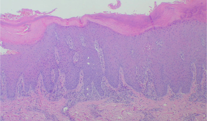 Trauma-Induced Psoriatic Arthritis: A Deep Köbner Phenomenon.