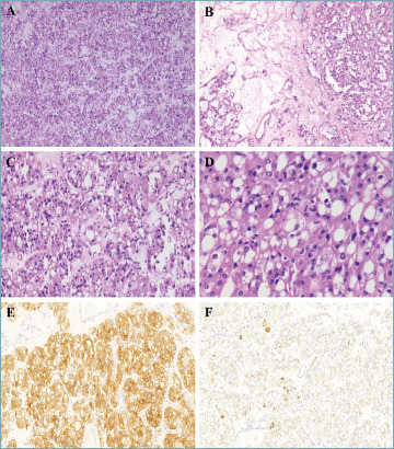 Eosinophilic vacuolated tumor of the kidney can have distant metastasis: a histo-molecular case study.