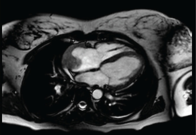 Diffuse alveolar hemorrhage as a clinical manifestation of cardiac angiosarcoma in a pregnant woman with antiphospholipid syndrome: case report and review of the literature.