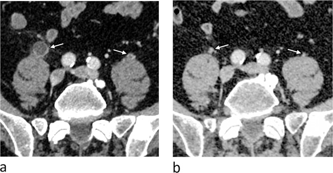 Cabazitaxel-induced ureteritis in metastatic castration-resistant prostate cancer patients: a single center case series 2014-2024.