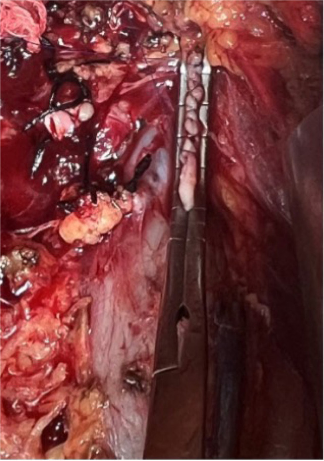 A Decade of Surgical Management of Renal Cell Carcinoma with IVC Thrombus and Bilateral Renal Tumors: Emphasis on Auto-transplantation.