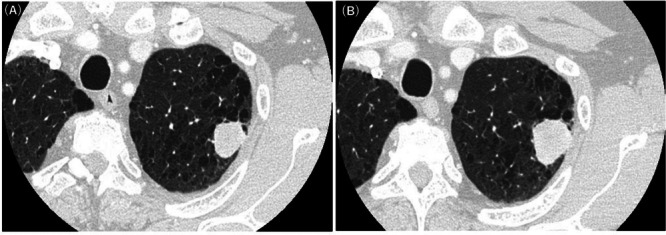 Pulmonary Carcinosarcoma Imitating Teratocarcinosarcoma: A Case Report.