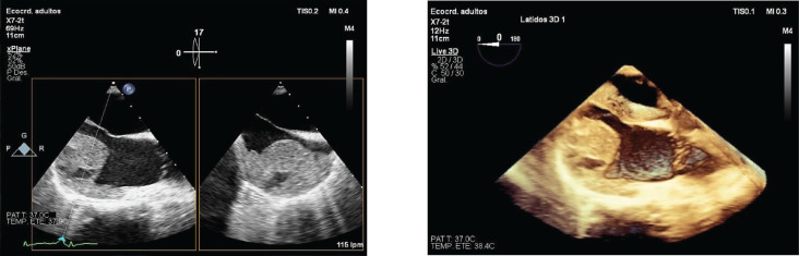 Diffuse alveolar hemorrhage as a clinical manifestation of cardiac angiosarcoma in a pregnant woman with antiphospholipid syndrome: case report and review of the literature.