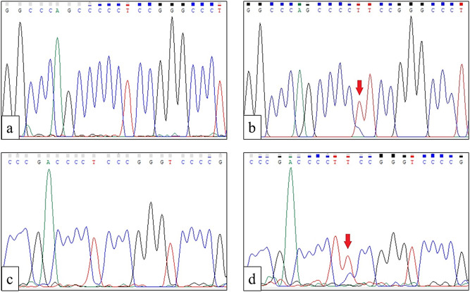 The ability of anexelekto (AXL) expression and TERT promoter mutation to predict radioiodine-refractory differentiated thyroid carcinoma.
