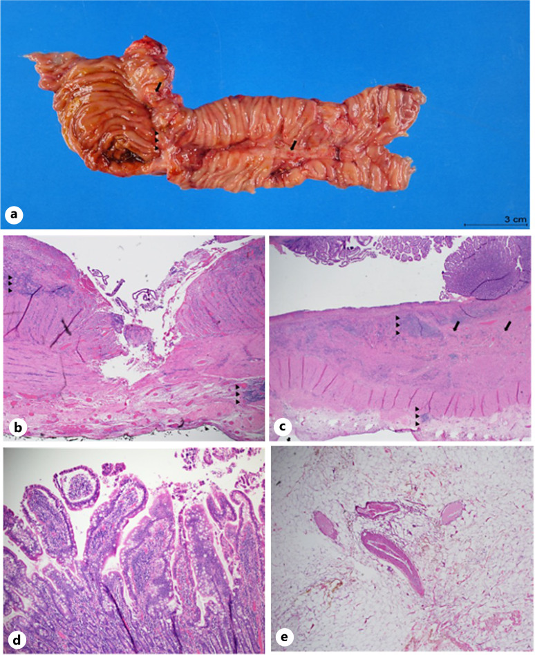 A Case Report: Cryptogenic Multifocal Ulcerative Stenosing Enteritis - A Diagnostic Challenge Mimicking Crohn's Disease.