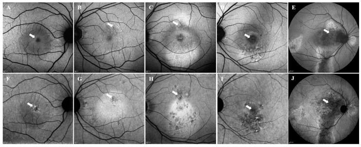 Short-Wavelength and Infrared Autofluorescence Imaging in Pachychoroid Neovasculopathy.