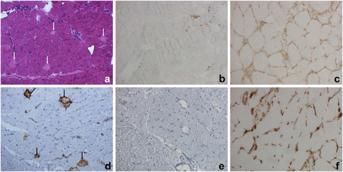 Fulminant Red Yeast Rice-Associated Rhabdomyolysis with Acute Liver Injury and Hyperkalemia Treated with Extracorporeal Blood Purification Using CytoSorb.