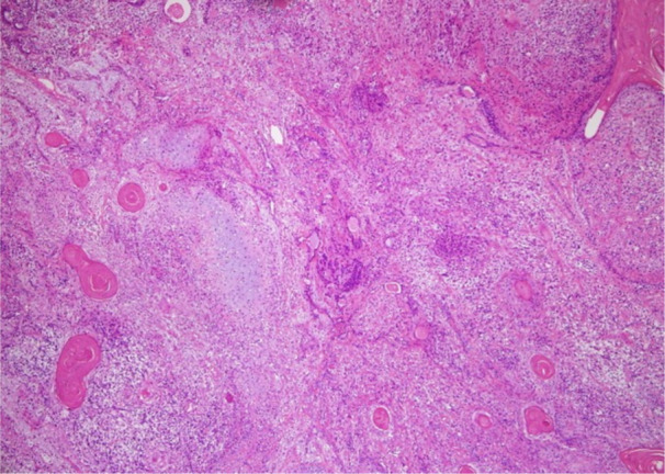 Pulmonary Carcinosarcoma Imitating Teratocarcinosarcoma: A Case Report.