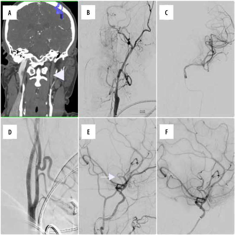 Endovascular stenting for extracranial internal carotid artery dissection - single-centre experience and literature overview.