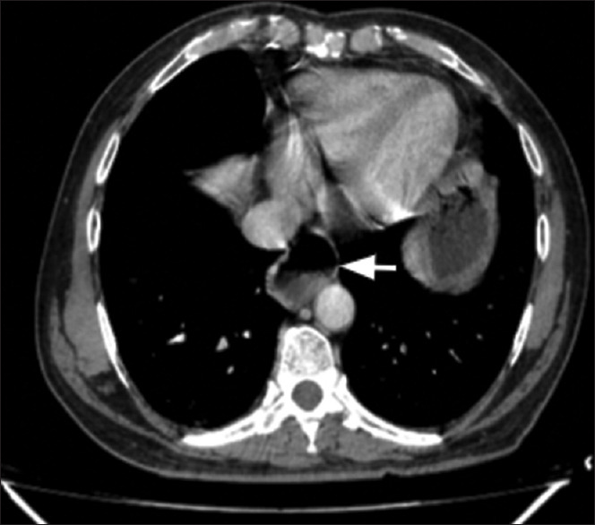 Computed tomography roadmap for post-operative fundoplication imaging with a novel structured reporting checklist.