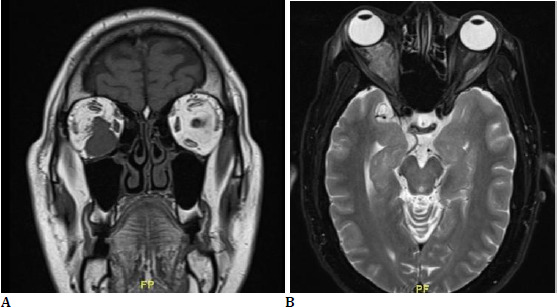 Orbital Metastasis from Hidradenocarcinoma.