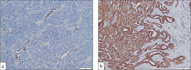 The ability of anexelekto (AXL) expression and TERT promoter mutation to predict radioiodine-refractory differentiated thyroid carcinoma.