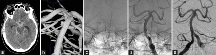 Flow diversion for acutely ruptured intracranial aneurysms: A single-center retrospective analysis of 30 consecutive cases.