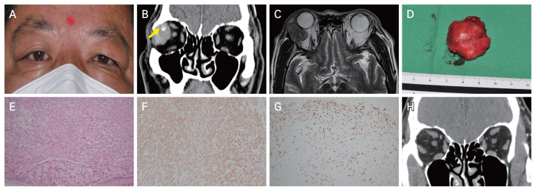 Lacrimal Gland Myoepithelial Carcinoma Managed with Surgical Excision and Radiation: A Case Report.