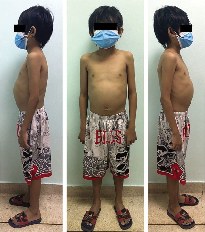 Hepatosplenic Schistosomiasis Presenting as Melena in an Adolescent Filipino Male: A Case Report and Literature Review.