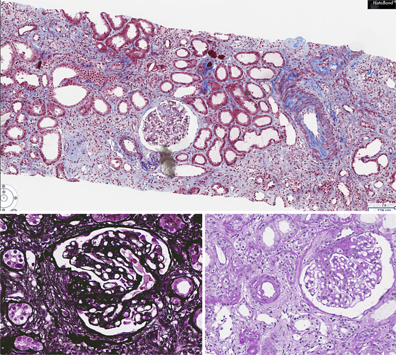Purtscher-Like Retinopathy with Renal Impairment: A Case Report and Review of the Literature.