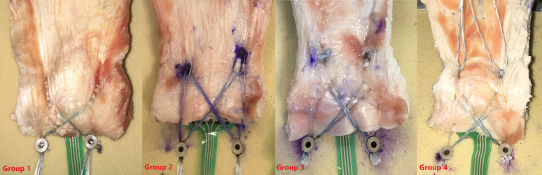 Biomechanical comparison of rotator cuff repair techniques in osteoporotic conditions: testing a novel technique.