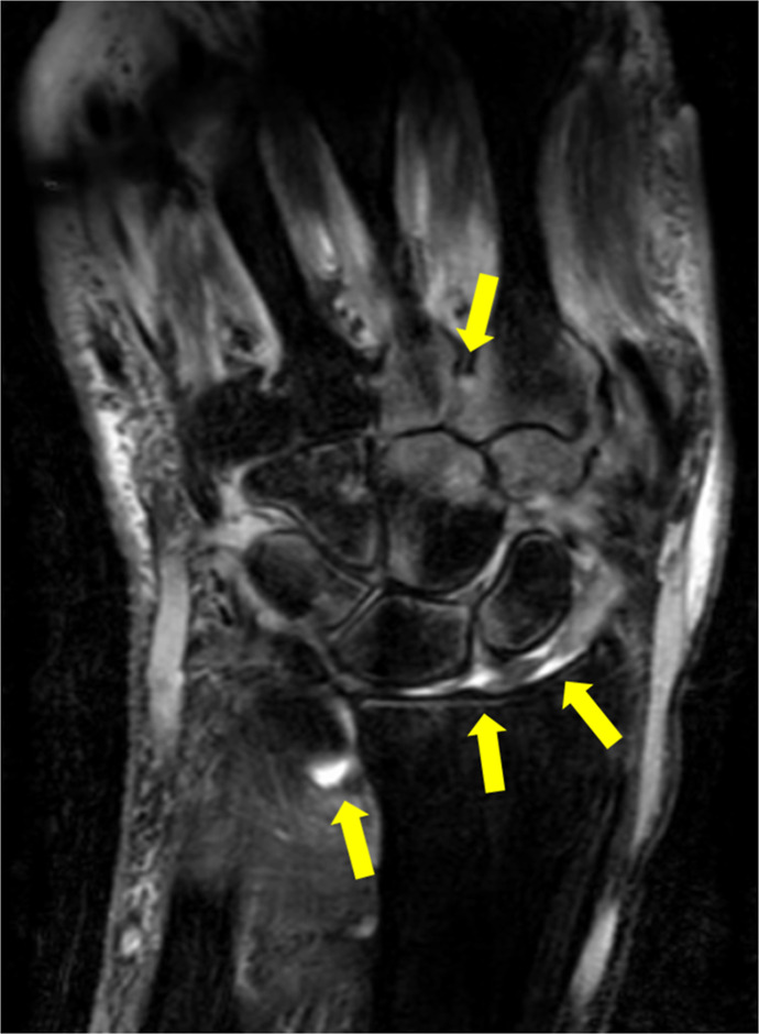 Trauma-Induced Psoriatic Arthritis: A Deep Köbner Phenomenon.