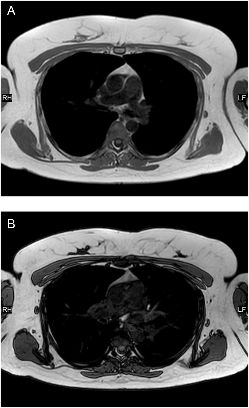 Multi-disciplinary collaboration in diagnosing thymic hyperplasia in a Graves' disease patient.