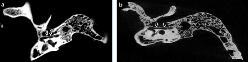 Comparison of cone beam-computed and micro-computed tomography data for measuring facial canal dehiscence.