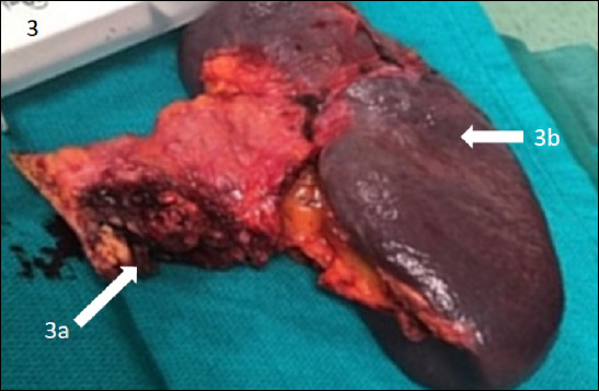 Case report and literature review of trophoblastic pancreatic carcinosarcoma presenting with gastric hemorrhage.