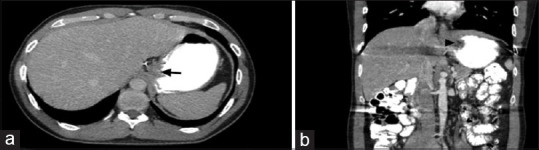 Computed tomography roadmap for post-operative fundoplication imaging with a novel structured reporting checklist.