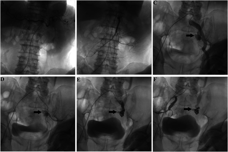 Massive lower gastrointestinal hemorrhage due to primary internal iliac arterial-sigmoid colon fistula.