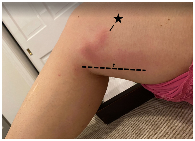 Retrospective study of hypersensitivity reactions in patients undergoing cyanoacrylate closure of lower extremity superficial veins