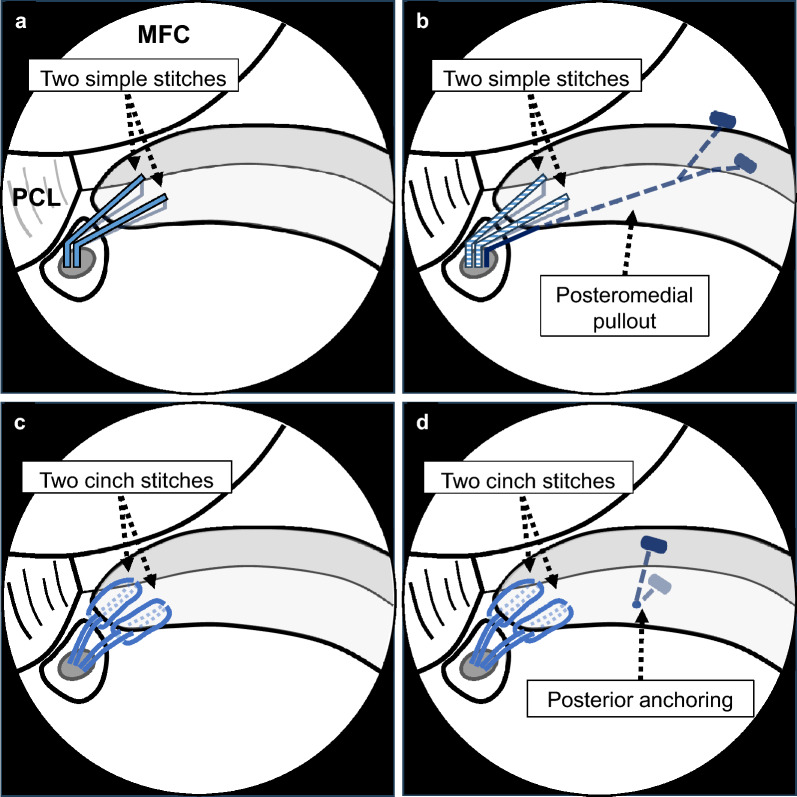 The preoperative flexion tear gap affects postoperative meniscus stability after pullout repair for medial meniscus posterior root tear.