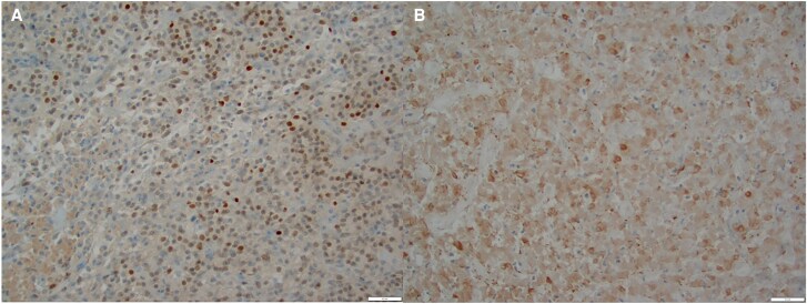 Thyroid-Stimulating Hormone/Growth Hormone Cosecreting Pituitary Adenoma With Normal Thyroid-Stimulating Hormone Level.