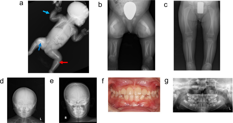 Effects of enzyme replacement therapy in sibling cases of hypophosphatasia of varying severities.