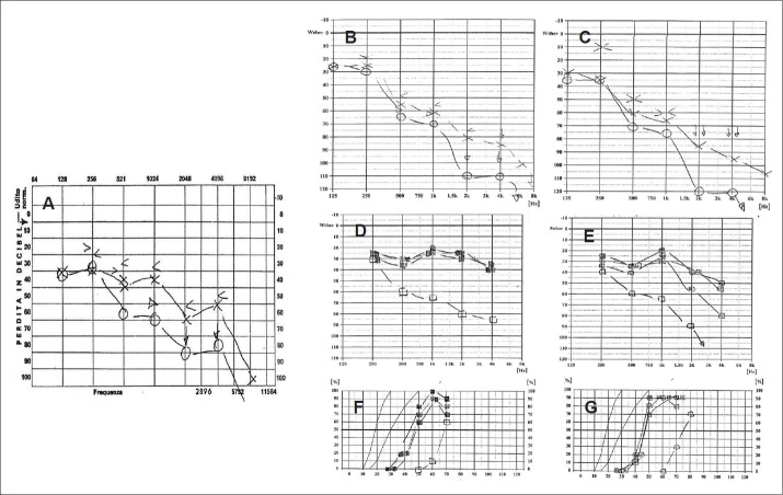 Advances in Understanding the Molecular Dynamics of Autosomal Dominant Auditory Neuropathy: Unveiling a Novel DIAPH3 Gene Variant Associated With Sensorineural Hearing Loss and Bilateral Vestibular Aqueduct Enlargement.