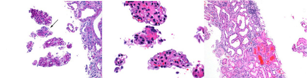 A Case of Hydralazine-Induced ANCA Vasculitis/Lupus Overlap Syndrome Presenting as Persistent Bicytopenia.