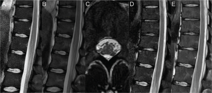 PARAPARESIS FOLLOWING PERIPHERAL AND CENTRAL NERVOUS SYSTEM LESIONS AFTER A LIGHTNING STRIKE - A CASE REPORT.