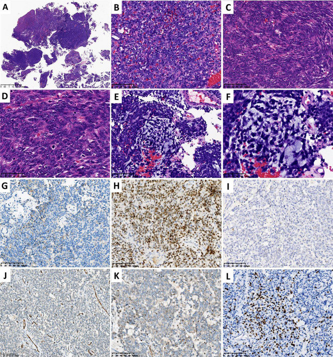 Pathologic and genomic characteristics of myoepithelioma-like tumor of the vulvar region: three case reports.