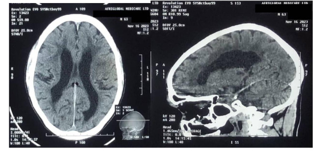 A Case of Lacunar Stroke in a Patient with Possible Normal Pressure Hydrocephalus (NPH).