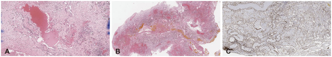 Radiation-Induced Cavernous Malformation in the Cerebellum: Clinical Features of Two Cases.