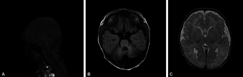 Infant with Known Dandy-Walker Malformation and Poor Feeding Found to Have Additional Diagnosis.