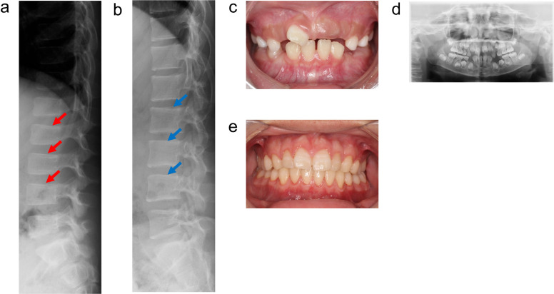 Effects of enzyme replacement therapy in sibling cases of hypophosphatasia of varying severities.