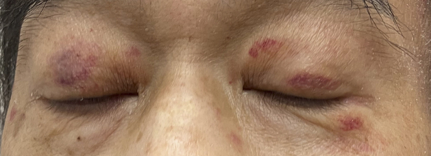 Periorbital Purpura as a Key Diagnostic Clue in Immunoglobulin Light Chain Amyloidosis.