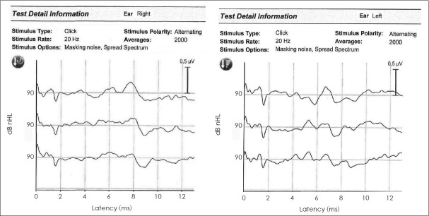 Advances in Understanding the Molecular Dynamics of Autosomal Dominant Auditory Neuropathy: Unveiling a Novel DIAPH3 Gene Variant Associated With Sensorineural Hearing Loss and Bilateral Vestibular Aqueduct Enlargement.
