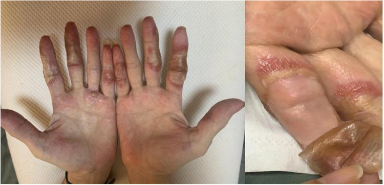 Management of Regorafenib-Induced Hand-Foot Skin Reaction with Topical Chinese Medicine and Urea Ointment: A Case Report and Literature Review.