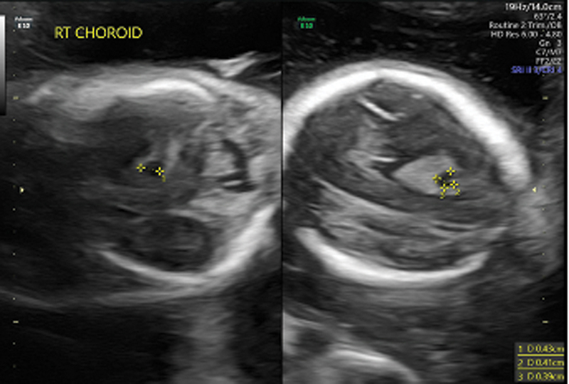 Infant with Known Dandy-Walker Malformation and Poor Feeding Found to Have Additional Diagnosis.